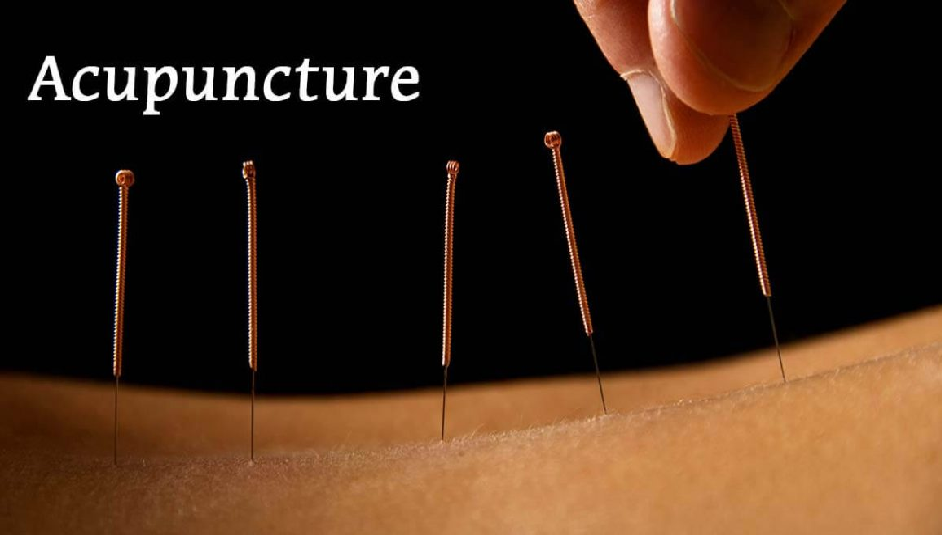 Acupuncture for Chronic Pain in Japan