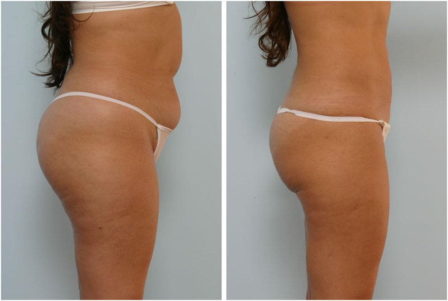 The Best Liposuction Guide For The Best Results