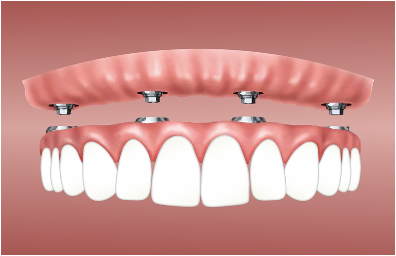 A Guide to Dental Implant Cost