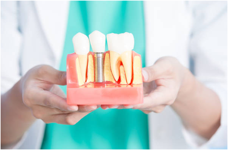 An overview of Bone Grafting Procedure for Dental Implants