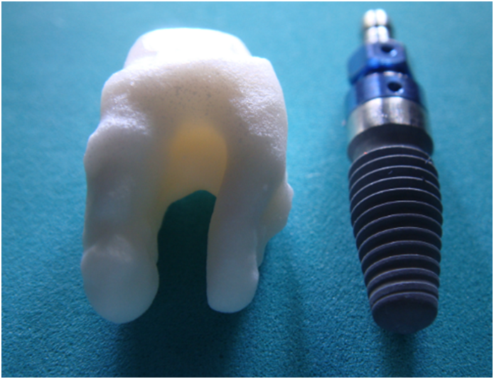 How can you Benefit from Dental Implants?