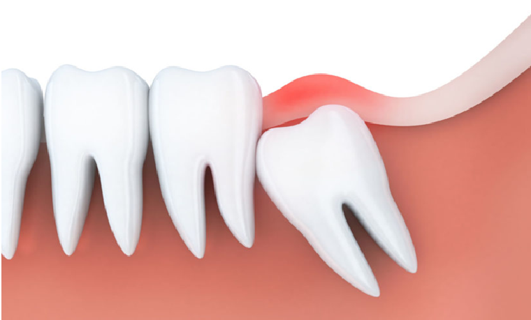 How Long Does It Take to Recover After Wisdom Teeth Removal?