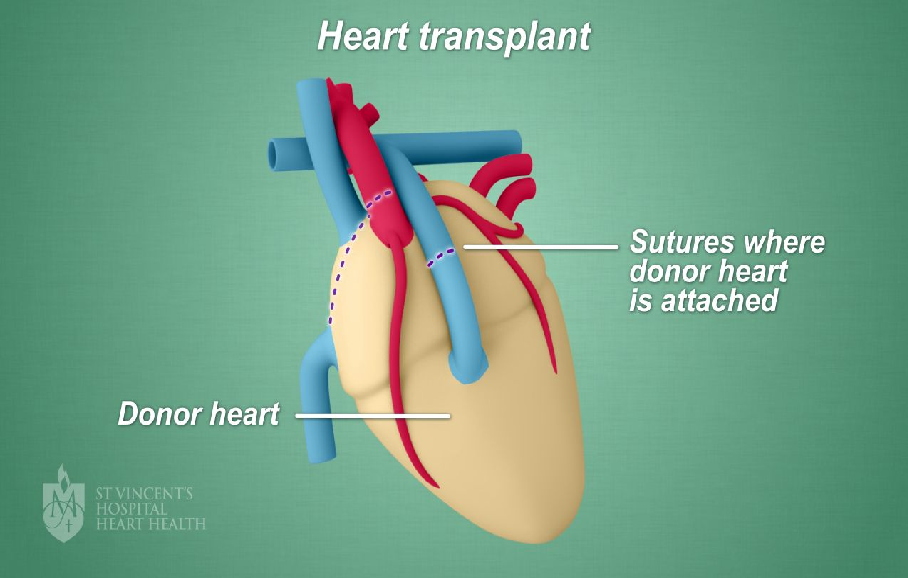 A Few Things to Know About Heart Transplants