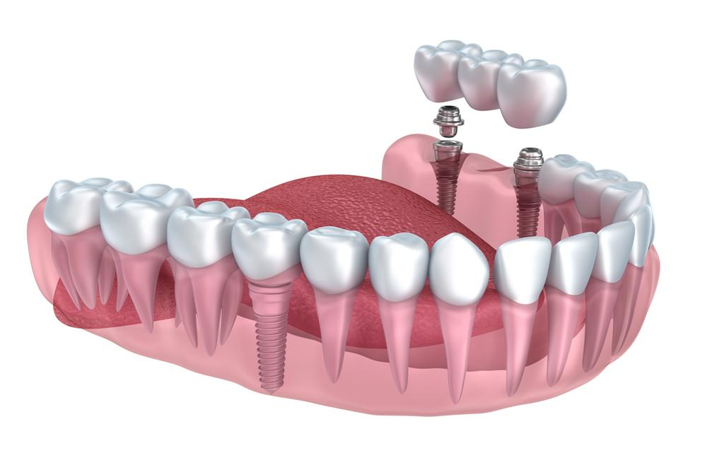 Are Dental Implants Safe for Older Adults
