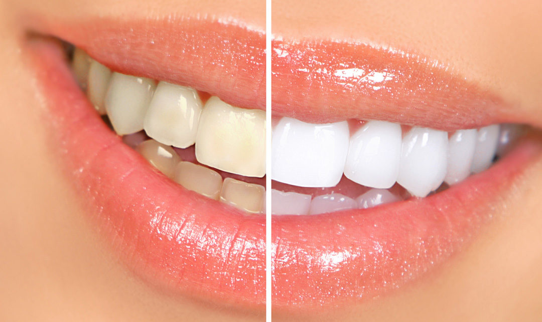 What Are The Benefits Of Teeth Whitening?