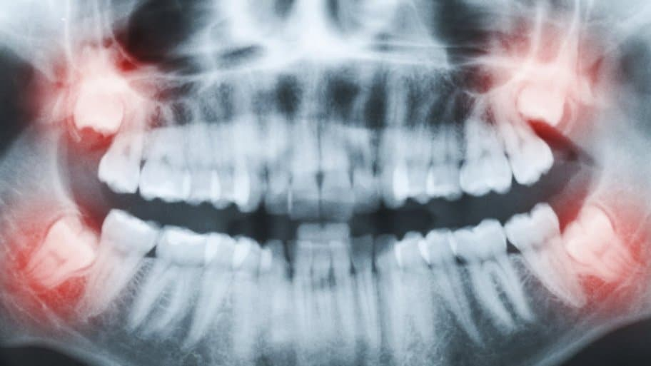 Is Wisdom Teeth Extraction Painful?