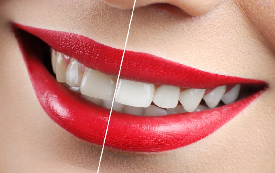 Show Off Your Bright Smile with Teeth Whitening – Here are 6 Benefits