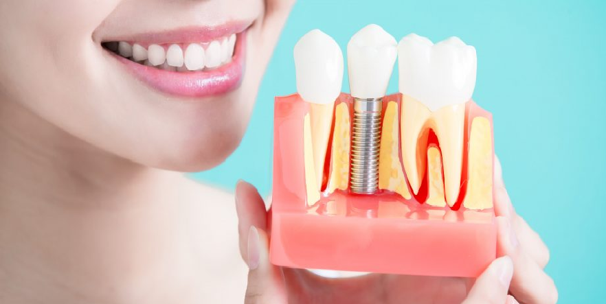 Why You Should Have Dental Implant?