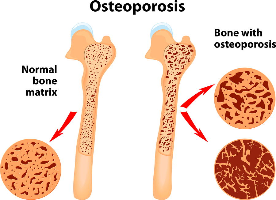 Learn What Osteoporosis Is and What Causes It!