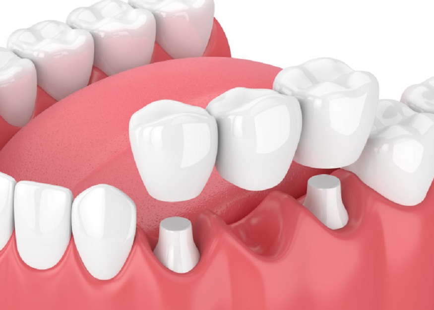 How to choose the best dental implant in Kolkata? Find it out here.