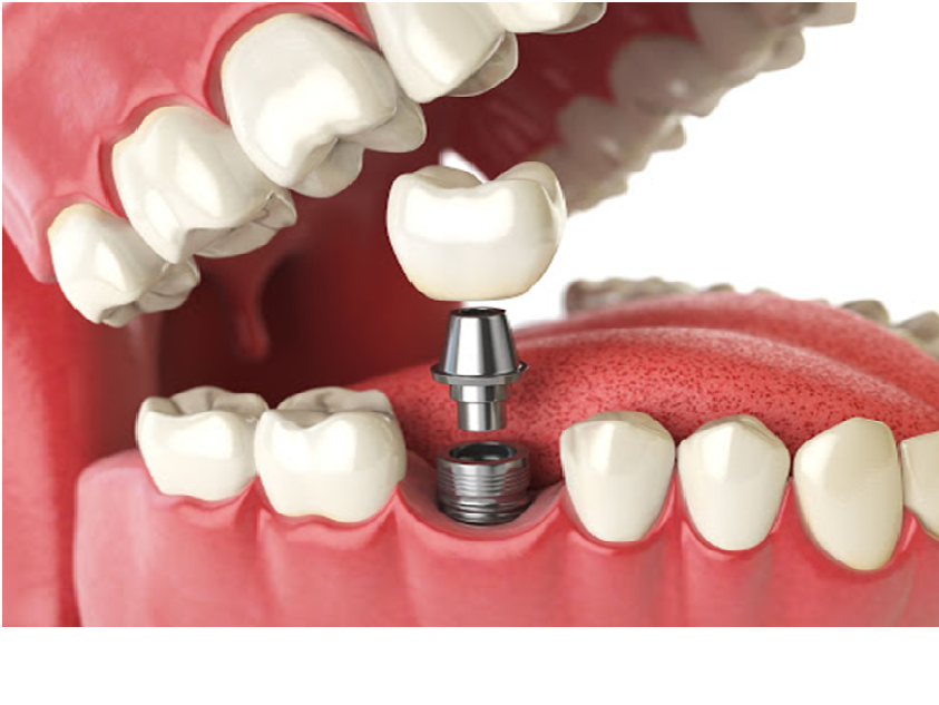 5 Tips For Finding the Best McAllen TX Dental Implant Service