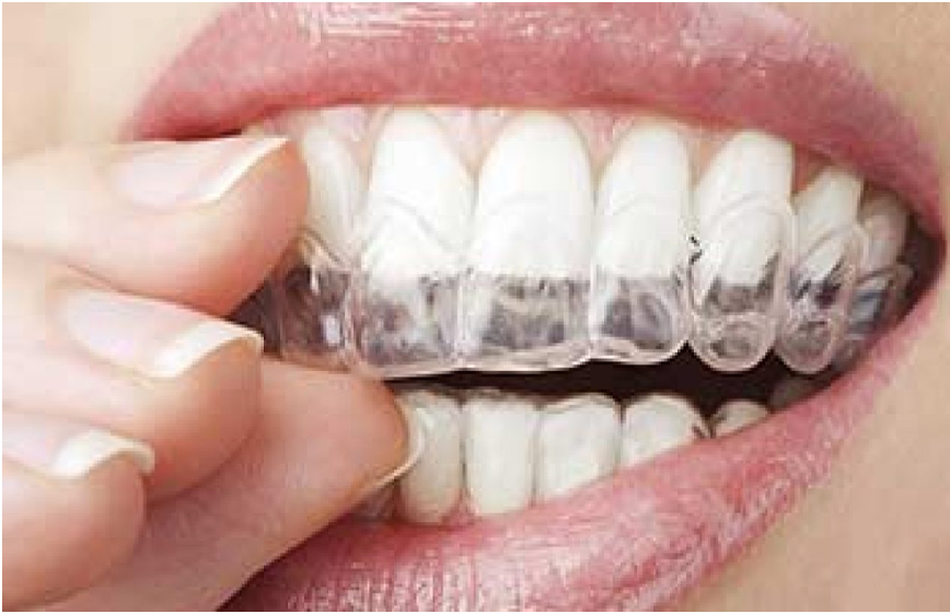 Learning More About Invisalign Before Having One