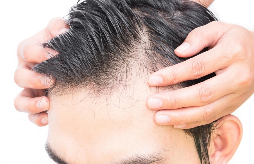 Top 5 Reasons for Hair Fall in Men