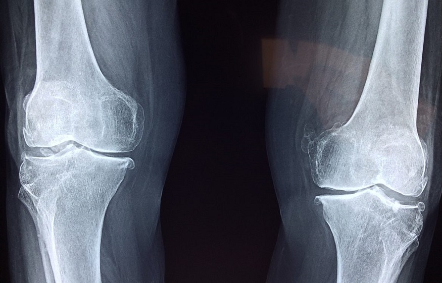 Osteoarthritis in the knee