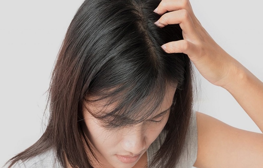 Treating itchy Scabs on the scalp with Seborrheic dermatitis shampoo