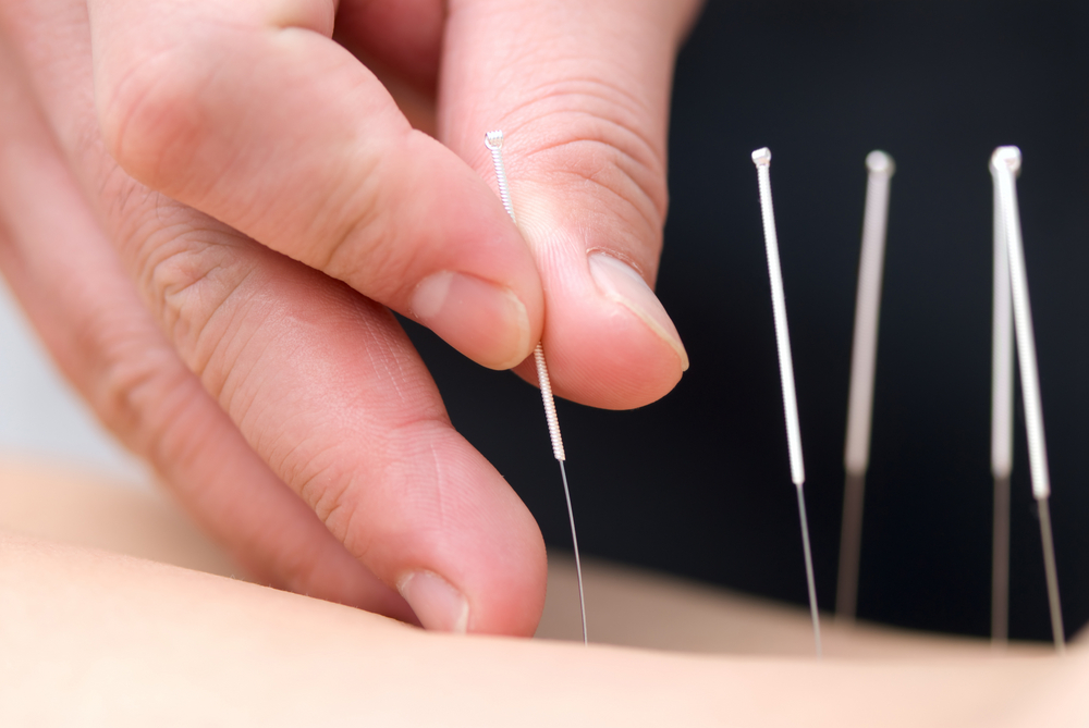 Top benefits of acupuncture treatment