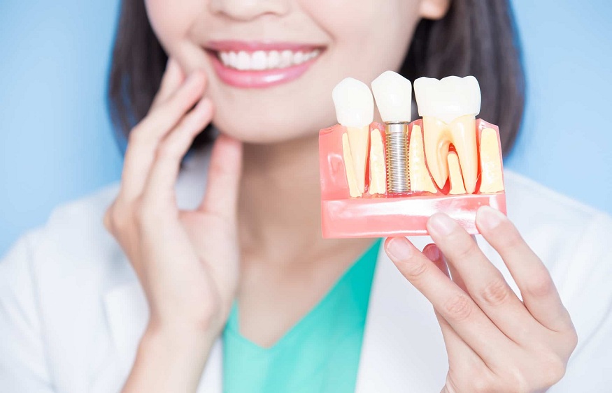 Understanding Dental Implants: The Pros and Cons of Teeth Implants in Harinavi