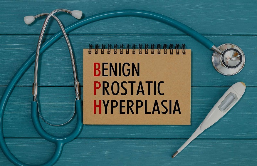 Understanding Benign Prostatic Hyperplasia (BPH): the Causes and Risk Factors