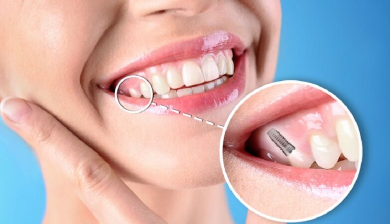 tooth replacement