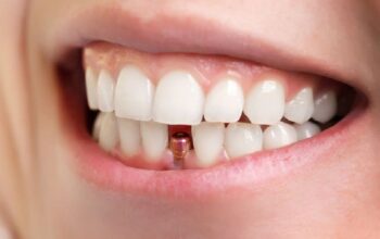 dental implants cost Melbourne