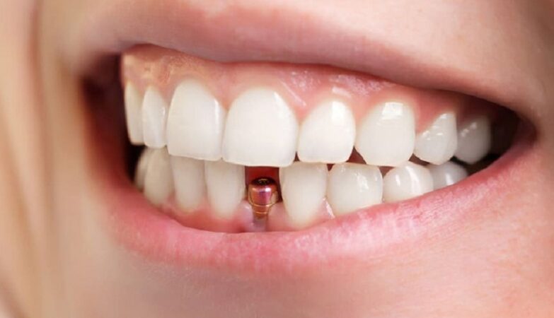 dental implants cost Melbourne