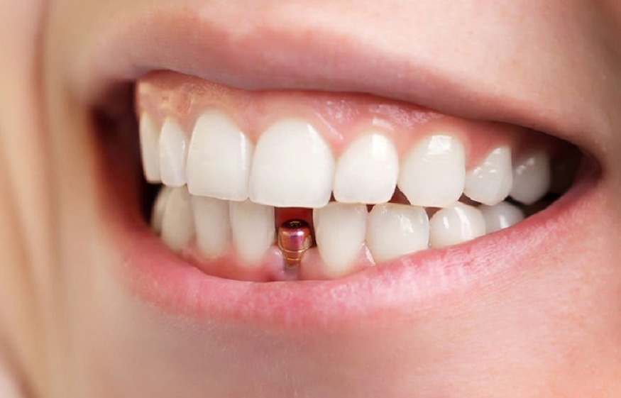 How to Finance Your Dental Implants Without Breaking the Bank