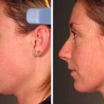 Ultherapy Indianapolis