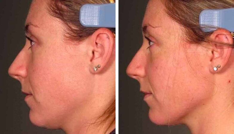 Ultherapy Indianapolis