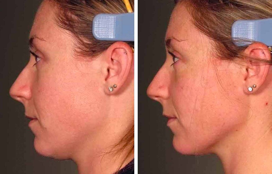 THE AREAS ULTHERAPY CAN TREAT AND THE ONES IT CAN’T