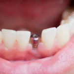 dental implants in San Francisco