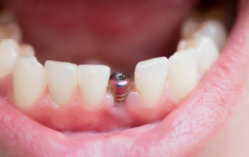 dental implants in San Francisco