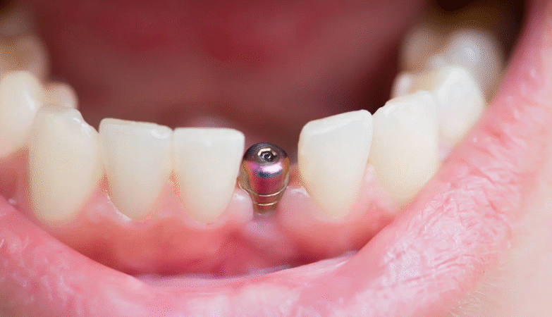 dental implants in San Francisco