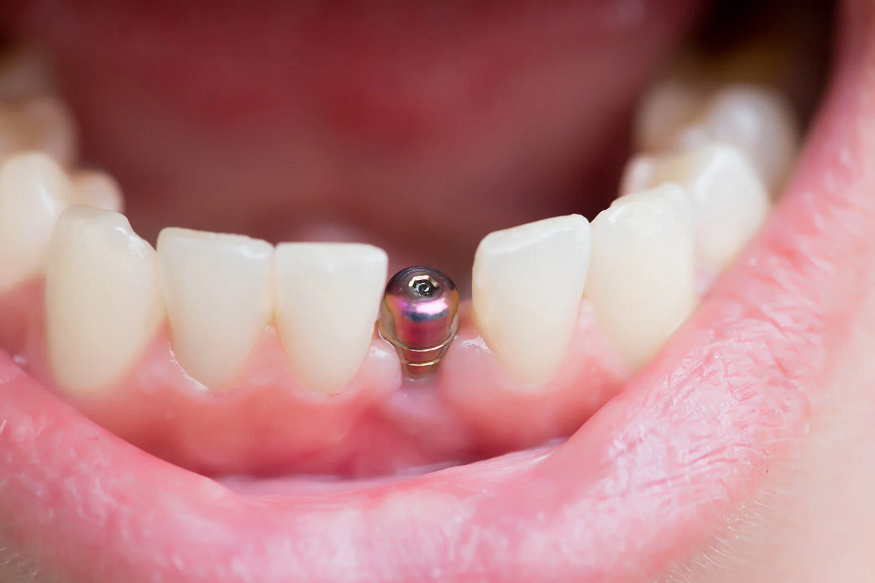 How Modern Dental Implants Are Transforming Smiles in San Francisco