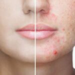 blemish removal Southampton