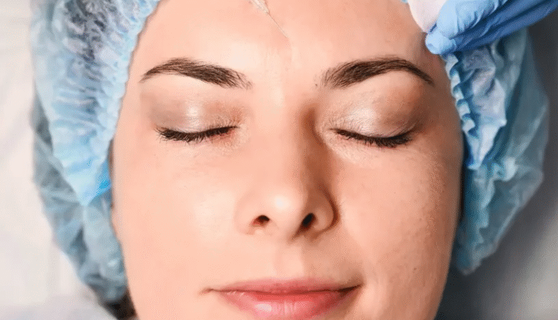 Botox brow lift