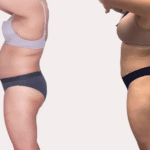 Arm Liposuction Cost in Charlotte