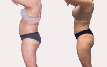 Arm Liposuction Cost in Charlotte