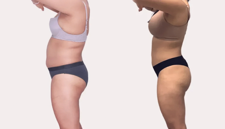 Arm Liposuction Cost in Charlotte