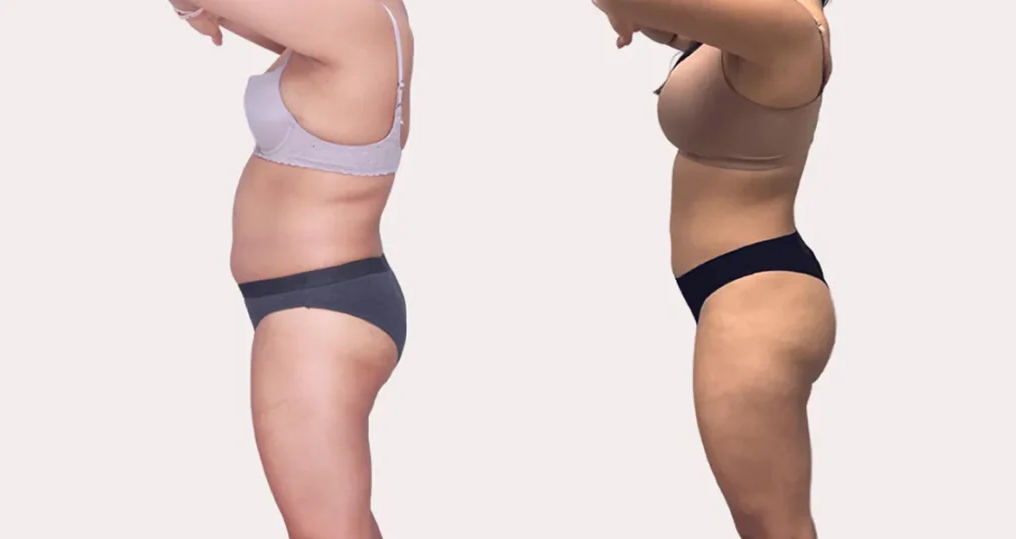 How Much Does Arm Liposuction Cost in Charlotte, NC? A Complete Pricing Guide