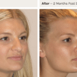non surgical rhinoplasty Sydney