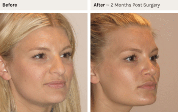 non surgical rhinoplasty Sydney