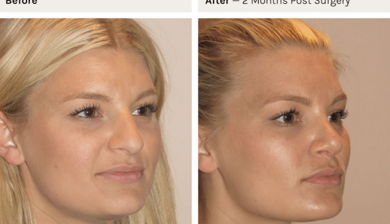 non surgical rhinoplasty Sydney