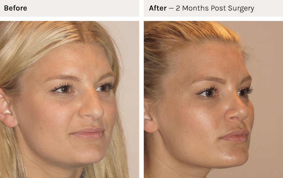 Non-Surgical Rhinoplasty for Facial Balance: What You Need to Know